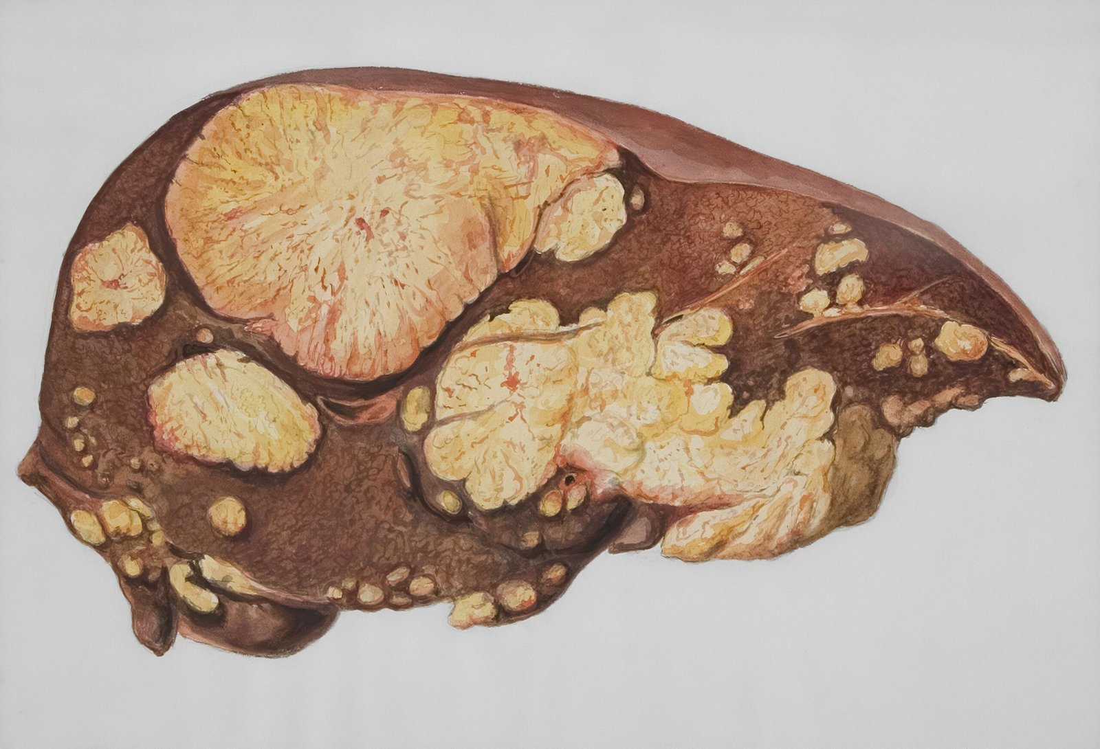 Non-Alcoholic Fatty Liver Disease (NAFLD): A Naturopathic Perspective